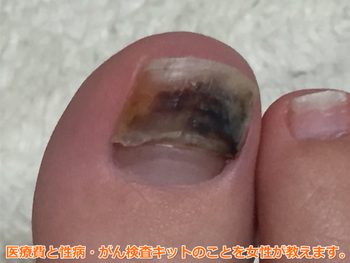 足の爪が剥がれた（7日目）1週間で亀裂入り。ガーゼで処置を継続。