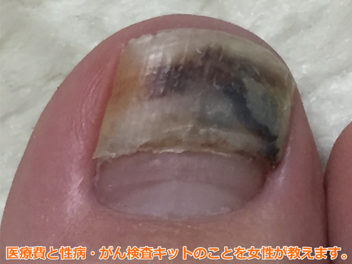 足の爪が剥がれた（21日目）入浴後に浮いた爪。