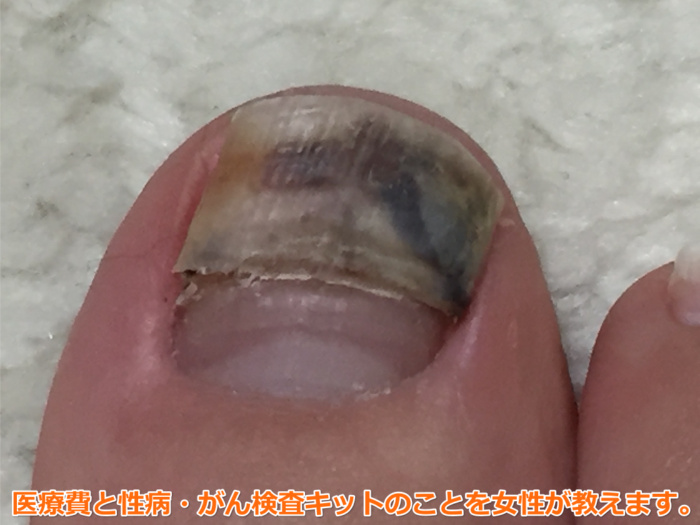 足の爪が剥がれた（28日目）亀裂が爪の三分の二まで進む。