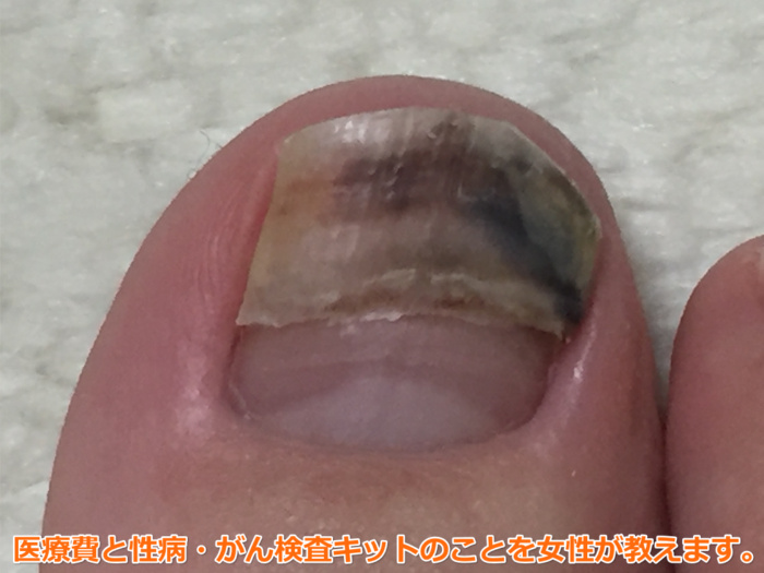 足の爪が剥がれた（35日目）新発見「爪は黒くない、白かった。」