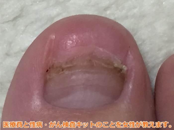 足の爪が剥がれた（42日目）事件！親指から爪が離れてなくなった。