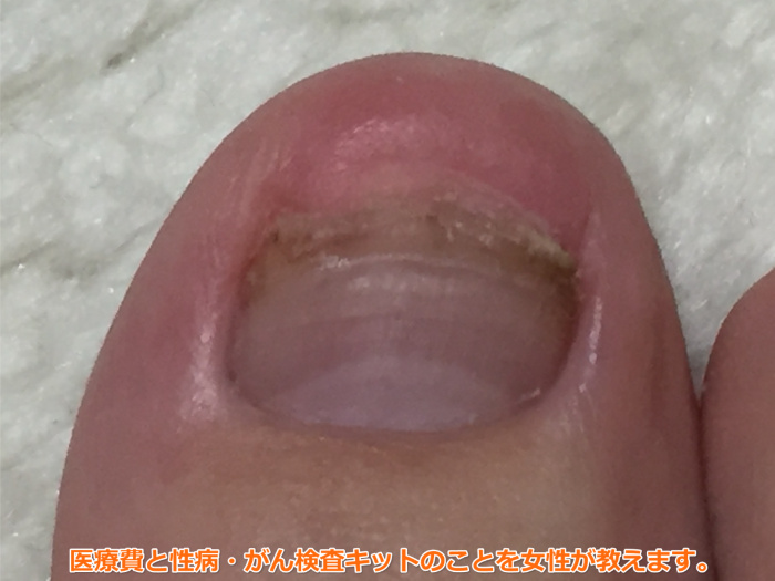 足の爪が剥がれた（49日目）爪がない指で歩いても日常生活に支障なし。