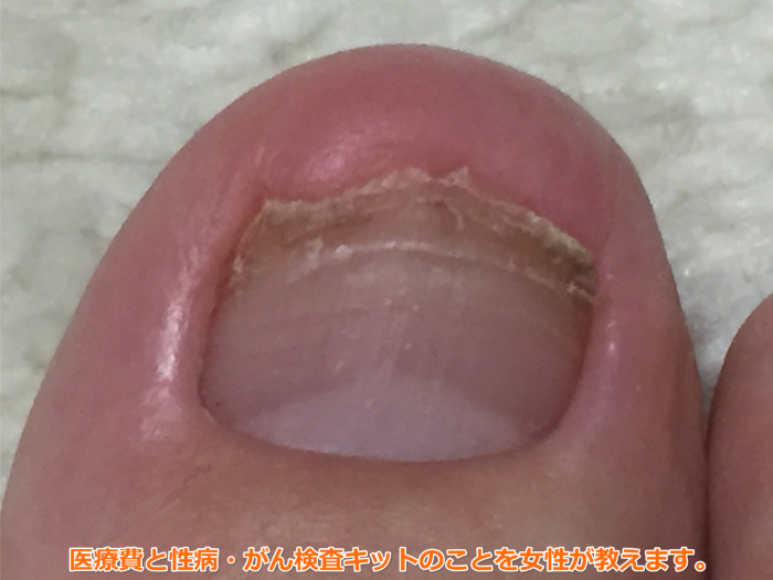 足の爪が剥がれた（63日目）経過良好。黒い爪もピンク色になった。