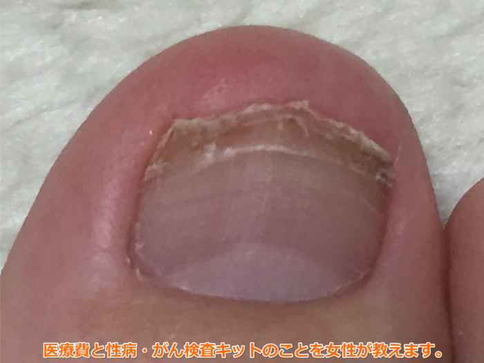 足の爪が剥がれた（70日目）古い爪が取れたら処置をしない方がいい？