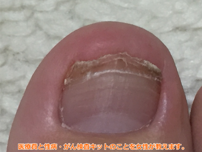 足の爪が剥がれた（77日目）ガーゼ処置をしなくても全く変化なし。